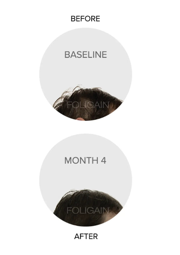 FOLIGAIN Triple Action Complete Formula For Thinning Hair For Women with 10% Trioxidil - FOLIGAIN CH