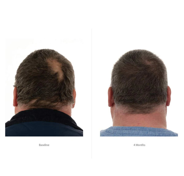 FOLIGAIN Triple Action Complete Formula For Thinning Hair For Men 10% Trioxidil - FOLIGAIN CH