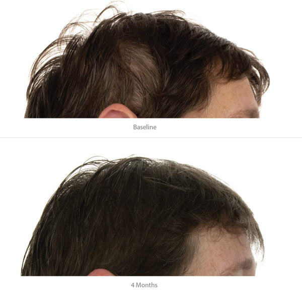 FOLIGAIN Advanced Hair Regrowth Hair Shampoo Minoxidil 2% - FOLIGAIN CH