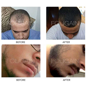 MINOXIDIL BEFORE AND AFTER 5