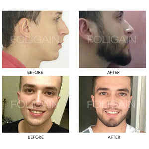 MINOXIDIL BEFORE AND AFTER 4