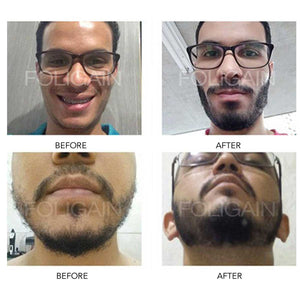 MINOXIDIL BEFORE AND AFTER 2