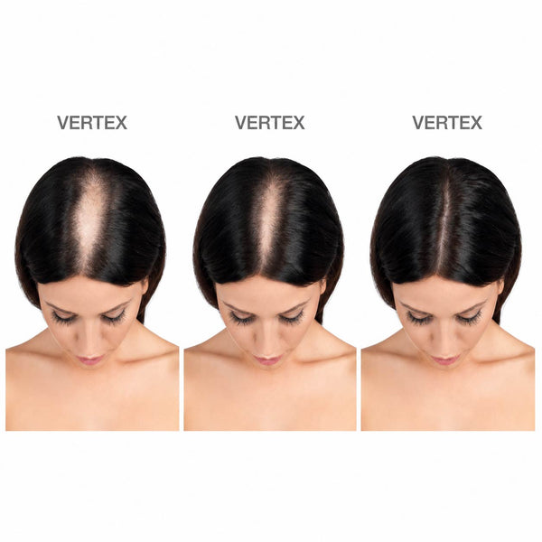 Kit de repousse des cheveux pour femmes FOLIGAIN® avec TRIOXIDIL® et Minoxidil 2%