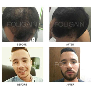 MINOXIDIL BEFORE AND AFTER 3