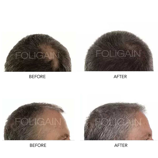 FOLIGAIN Men's Hair Regrowth Kit (Standalone) - FOLIGAIN CH