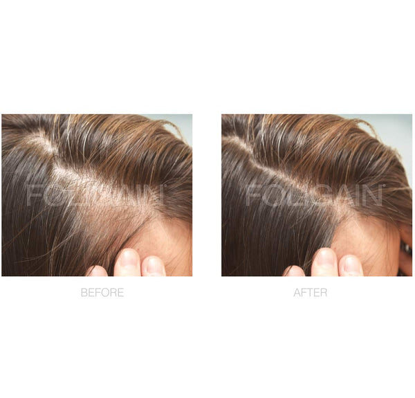 FOLIGAIN Minoxidil 2% Traitement de repousse des cheveux pour femmes 6 mois d'approvisionnement