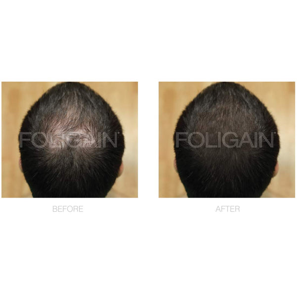 FOLIGAIN Minoxidil 5 % Haarwuchsbehandlung für Männer, 6-Monatspackung