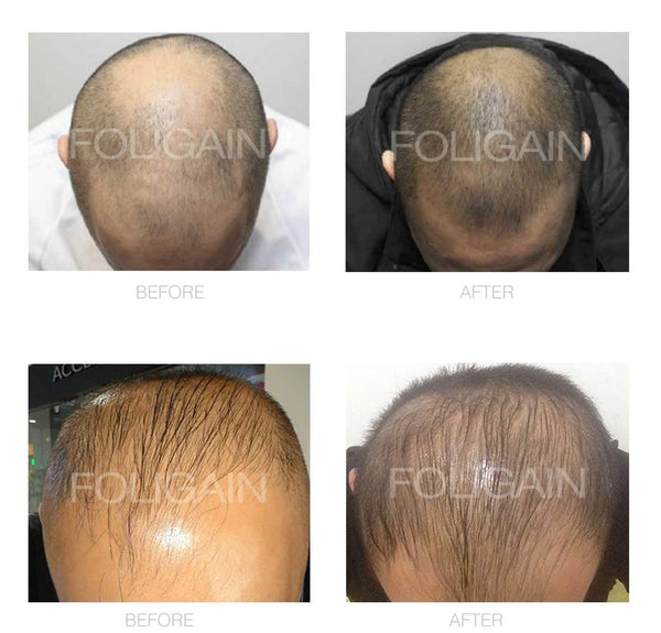 FOLIGAIN Minoxidil 5% a basso contenuto di alcol Trattamento per la ricrescita dei capelli per uomo Fornitura per 12 mesi