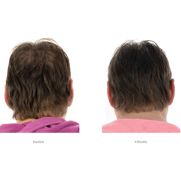 FOLIGAIN Hair Growth Shampoo + Conditioner Kit For Women (Standalone) - FOLIGAIN CH